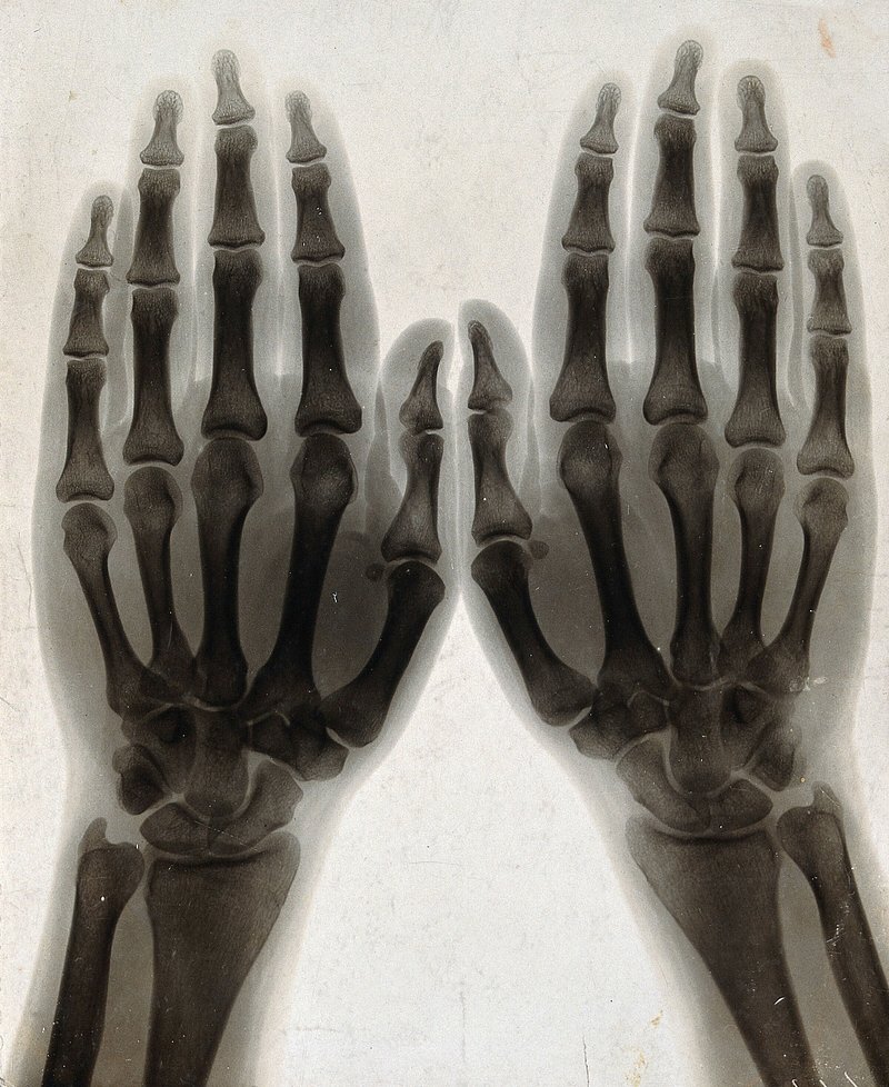 X-ray image of two human hands showing skeletal structure